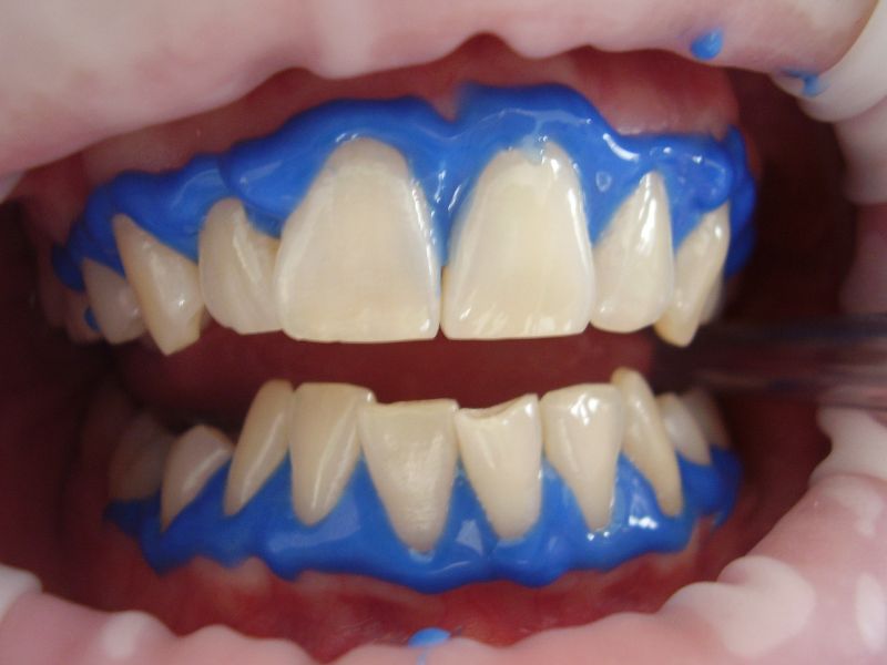 Blanqueamiento Dental en Pacientes Sensibles